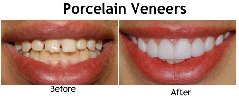 Veneer Porselen- Global Estetik Dental Care